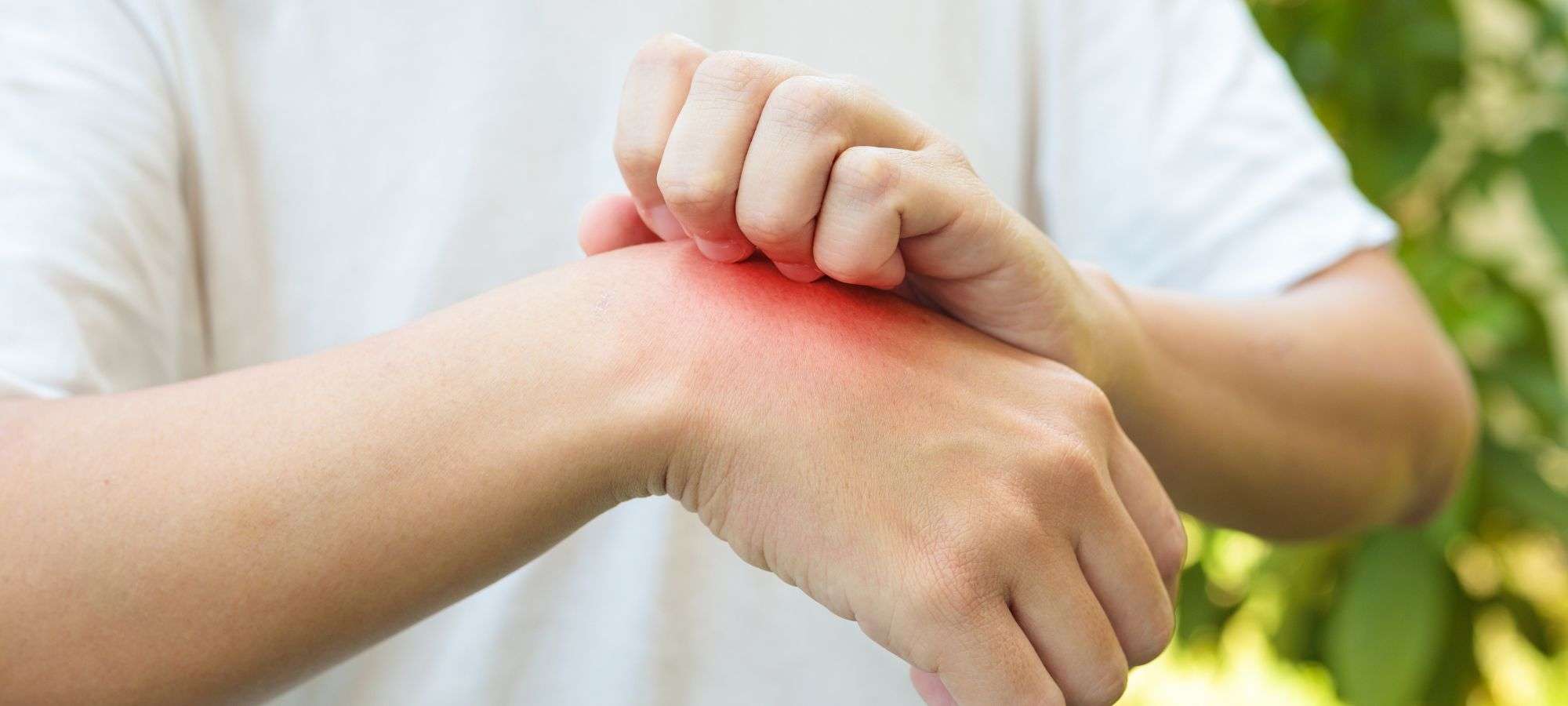 Infected Insect Bites at Southdowns Pharmacy
