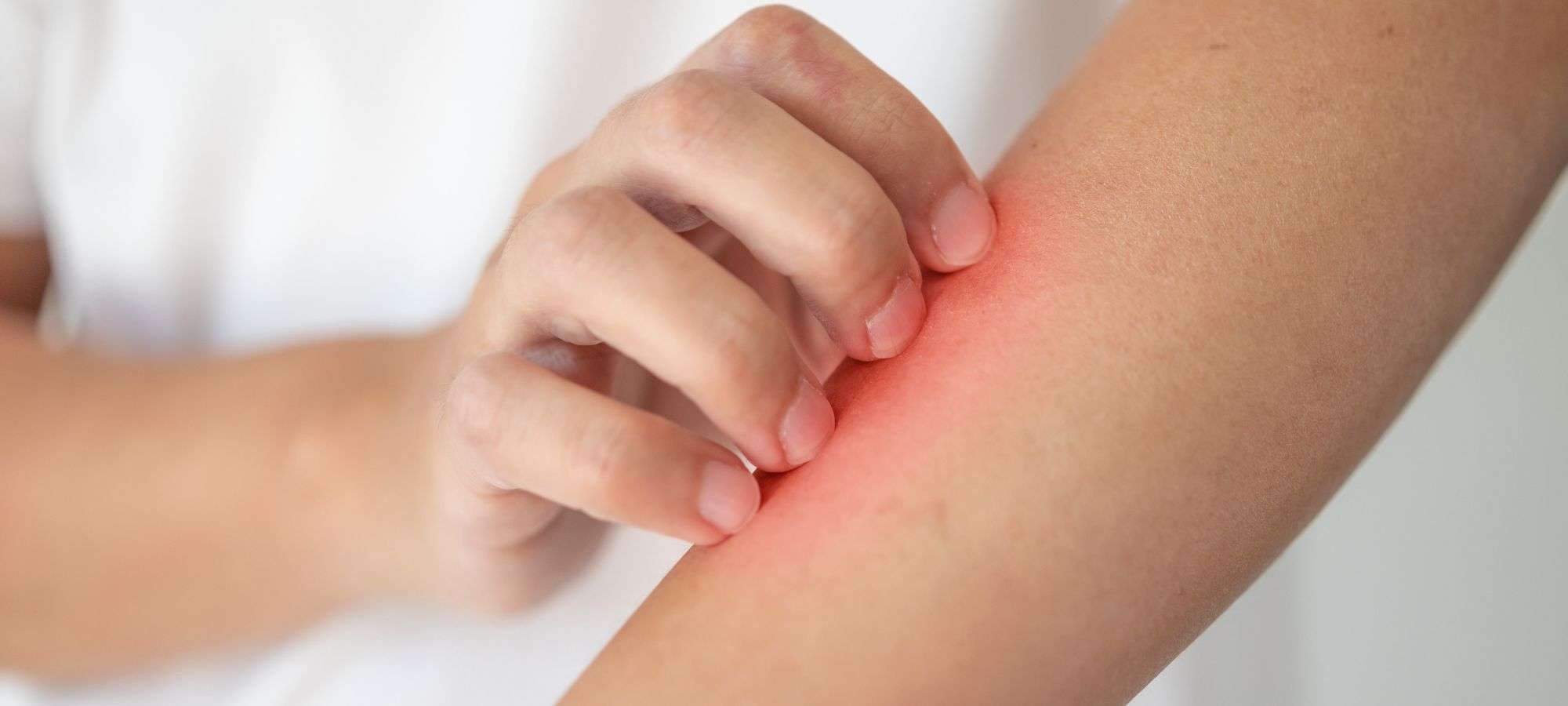 Impetigo Treatment at Southdowns Pharmacy