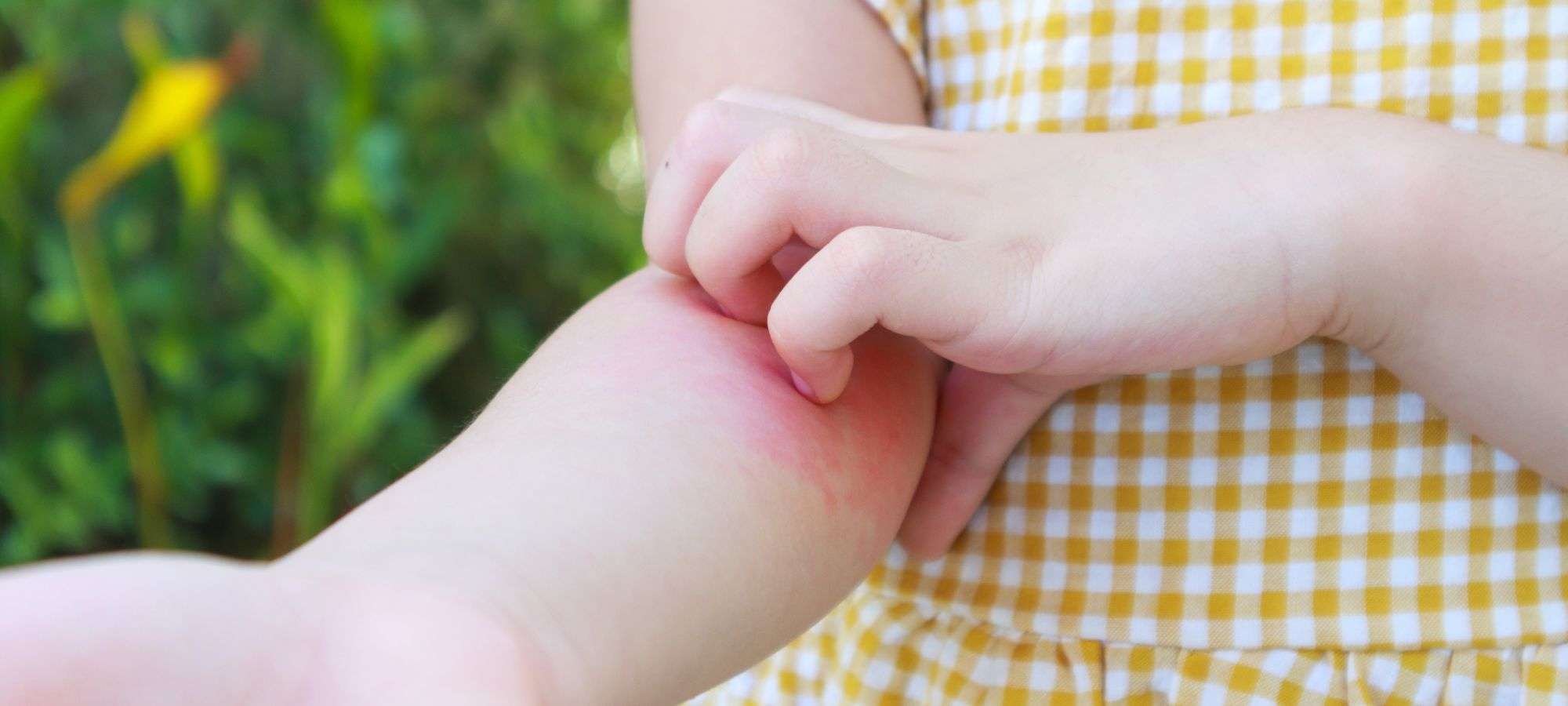 Shingles Treatment at Southdowns Pharmacy