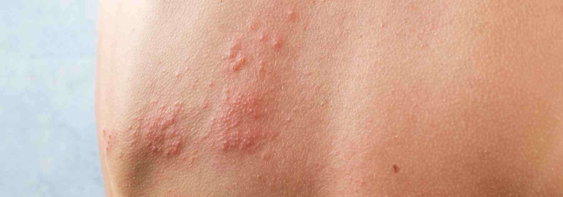 Shingles treatment in Hampshire focuses on soothing and solutions.