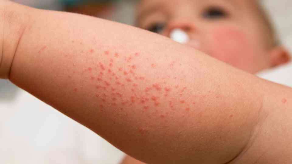 Understand the difference between impetigo and cold sores