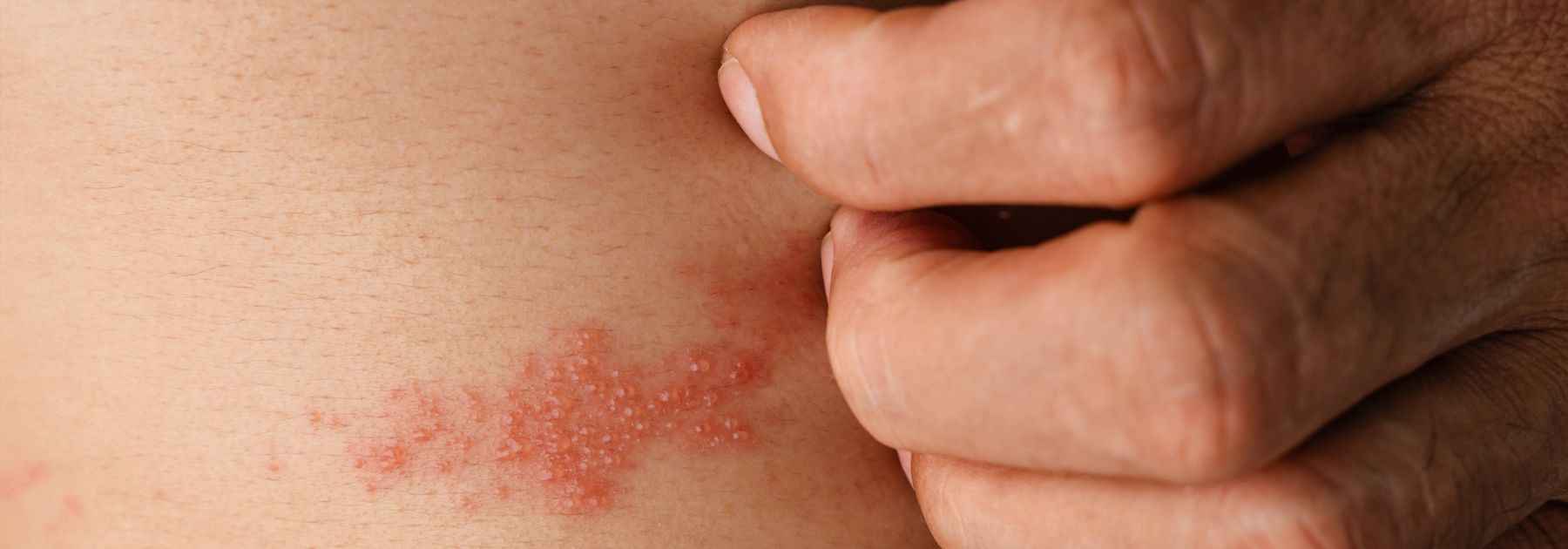 shingles vaccine eligibility