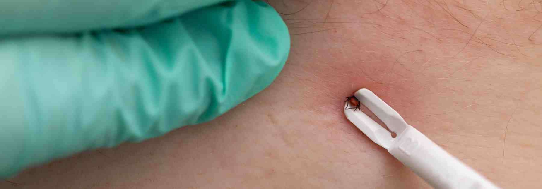 Treat infected insect bites with cream